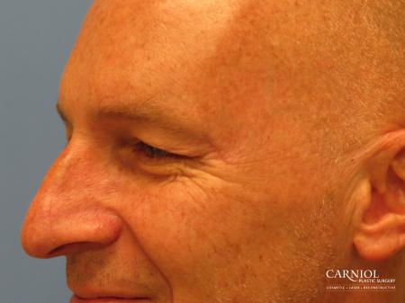 Eyelid Surgery: Patient 1 - After Image 3