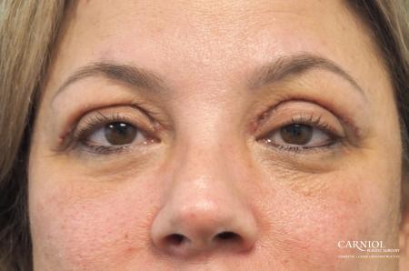 Blepharoplasty: Patient 1 - After Image 1