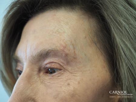 Scars: Patient 1 - After Image 1
