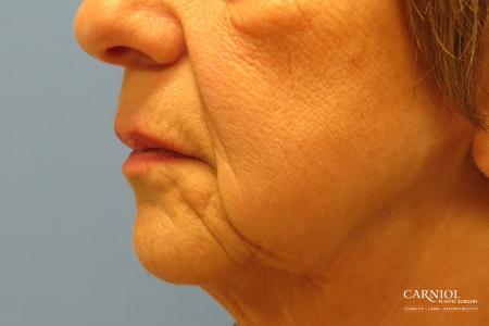 Non-Surgical Mini-Facelift: Patient 9 - Before and After Image 3