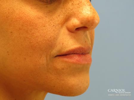 Scar Revision: Patient 3 - Before Image 3