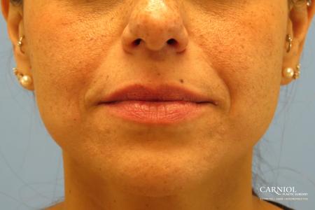 Lip Augmentation: Patient 1 - Before and After Image 4