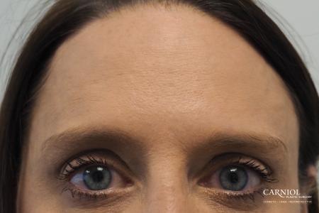 BOTOX® Cosmetic: Patient 4 - After Image