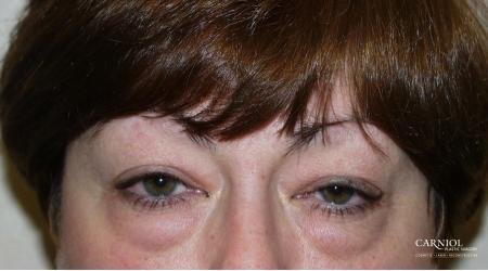 Eyelid Lift: Upper and Lower Blepharoplasty - Before Image 1