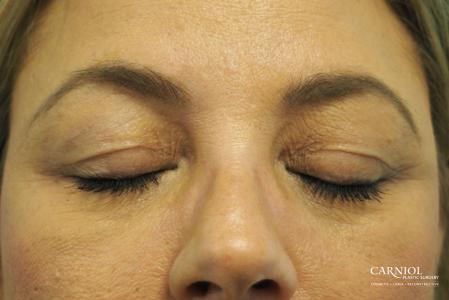 Blepharoplasty: Patient 1 - Before and After Image 2