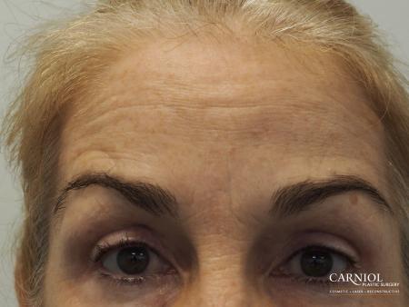 BOTOX® Cosmetic: Patient 5 - After Image 2