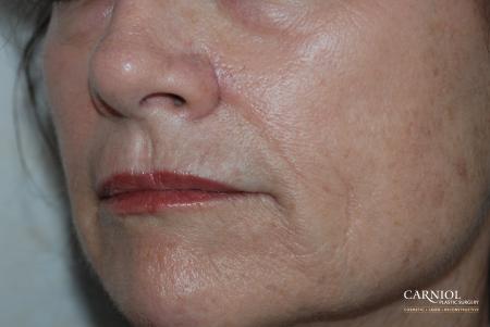 Skin Cancer Reconstruction - Face: Patient 3 - After Image 1