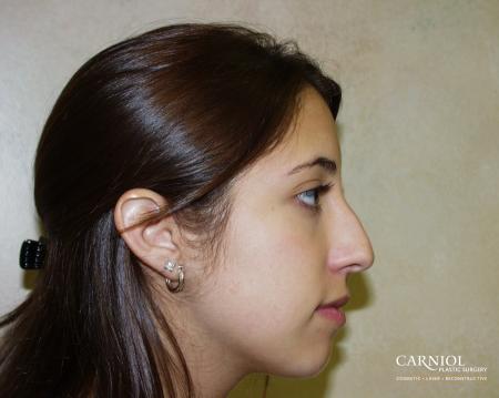Rhinoplasty: Patient 1 - Before Image 1