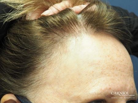 Nonsurgical Hair Restoration: Patient 1 - After Image 2