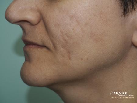 Acne Scars: Patient 2 - After Image 1