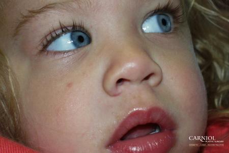 Hemangioma: Patient 2 - After Image 1