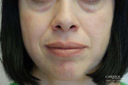 Fillers: Patient 2 - Before Image 1