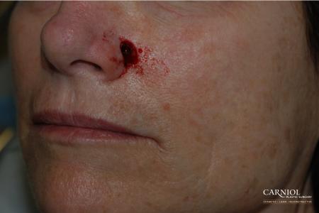 Skin Cancer Reconstruction - Face: Patient 3 - Before Image 1