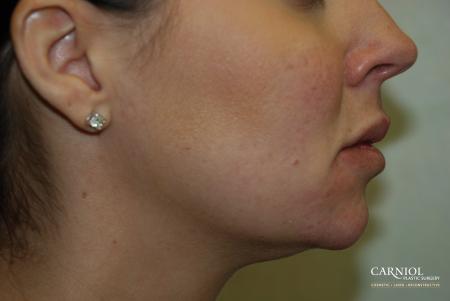 Non-Surgical Mini-Facelift: Patient 4 - After Image 1