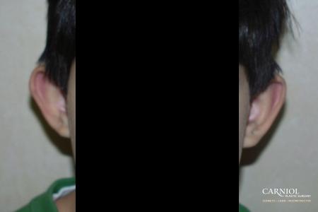 Otoplasty: Patient 2 - Before Image 1