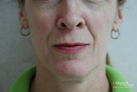 Fillers: Patient 1 - Before Image 1