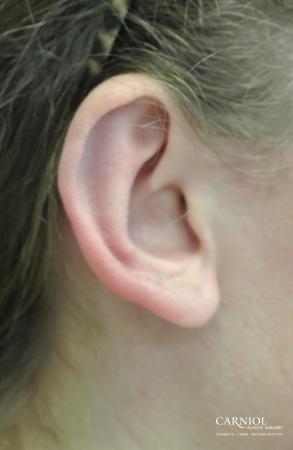 Ear Pinning - After Image 2
