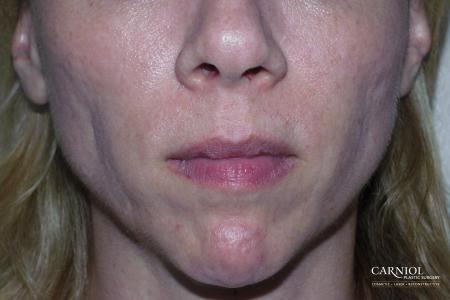 Facial Tightening: Patient 8 - Before Image 1