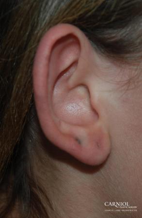 Ear Pinning - Before and After Image 2