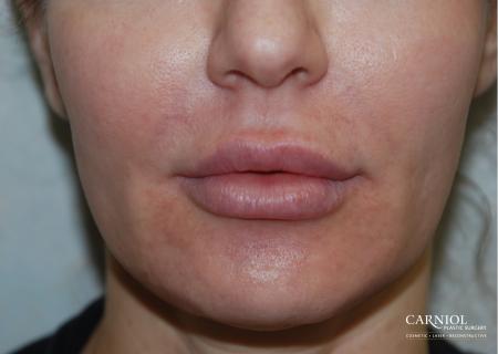 Lip Augmentation: Patient 5 - After Image 1