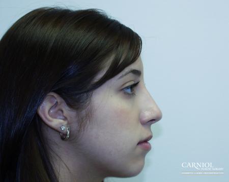 Rhinoplasty: Patient 1 - After Image 1
