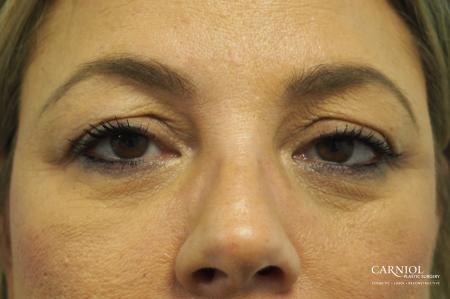 Blepharoplasty: Patient 1 - Before Image 1