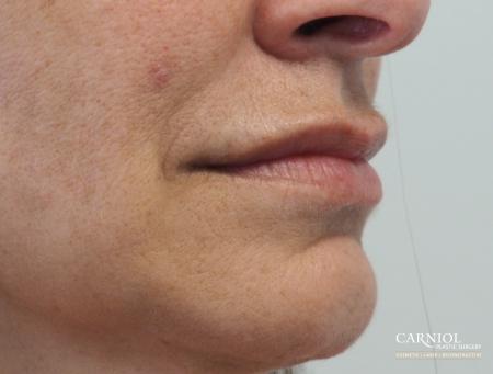 Lip Augmentation: Patient 8 - After Image 2