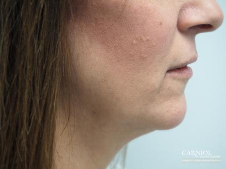 Non-Surgical Neck Lift: Patient 1 - After Image 1