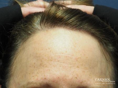 Nonsurgical Hair Restoration: Patient 1 - After Image 1