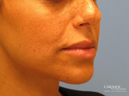 Scar Revision: Patient 3 - After Image 3