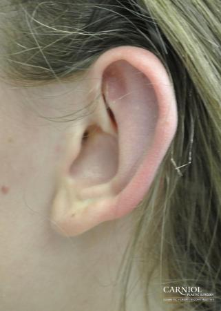 Ear Pinning - After Image 1