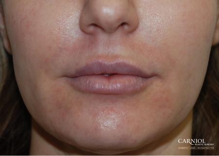 Lip Augmentation: Patient 5 - Before Image 1