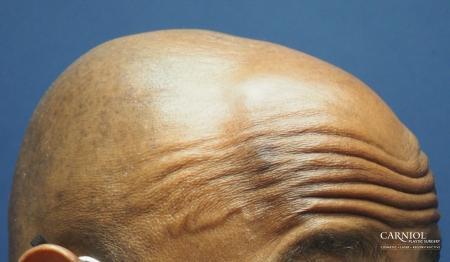 Mole/Age Spot Removal: Patient 3 - Before and After Image 2