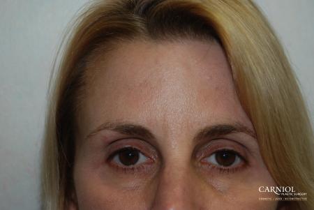 BOTOX® Cosmetic: Patient 1 - After Image