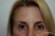BOTOX® Cosmetic: Patient 1 - After Image