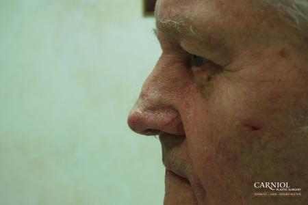 Skin Cancer Reconstruction - Face: Patient 8 - After Image 1
