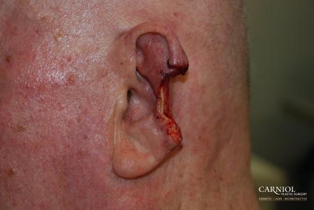 Skin Cancer Reconstruction - Face: Patient 1 - Before Image 1
