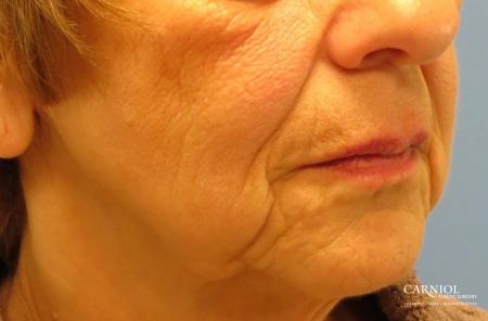Non-Surgical Mini-Facelift: Patient 9 - Before Image 2