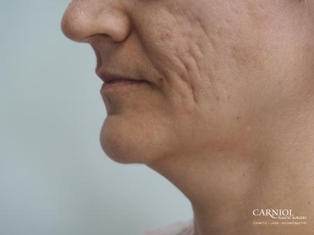 Acne Scars: Patient 2 - Before Image 1