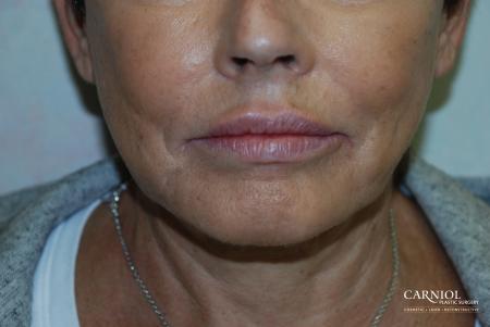 Lip Augmentation: Patient 4 - After Image 1