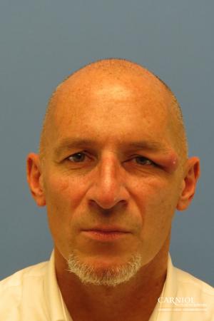 Eyelid Surgery: Patient 1 - Before Image 1