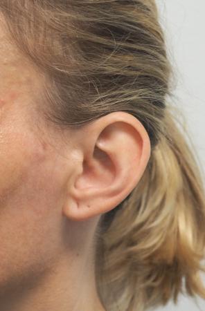 Otoplasty: Patient 3 - Before Image 4