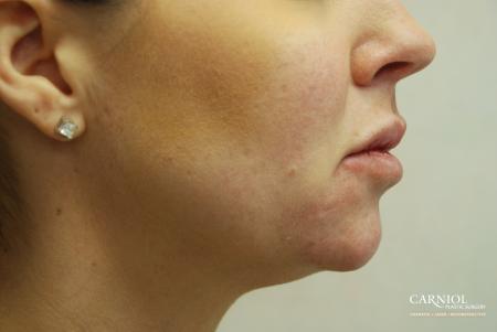 Non-Surgical Mini-Facelift: Patient 4 - Before Image 1