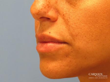 Scar Revision: Patient 3 - After Image 2
