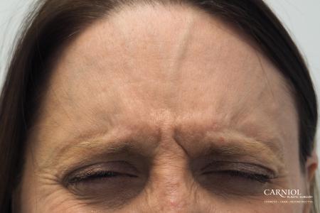 BOTOX® Cosmetic: Patient 4 - Before and After Image 3