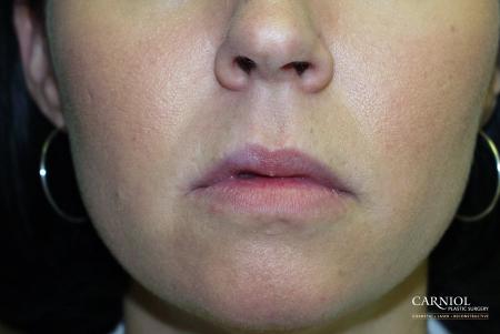 Lip Augmentation: Patient 3 - Before Image 1