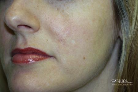 Acne Rejuvenation: Patient 2 - After Image 1