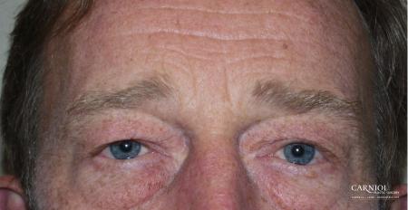 Eyelid Lift: Patient 3 - Before Image 1
