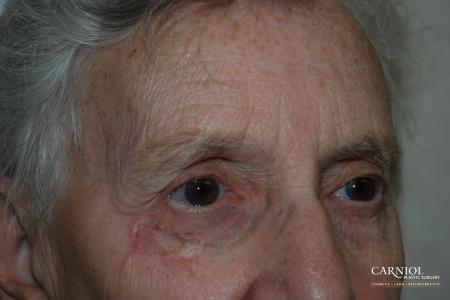 Skin Cancer Reconstruction - Face: Patient 5 - After Image 1