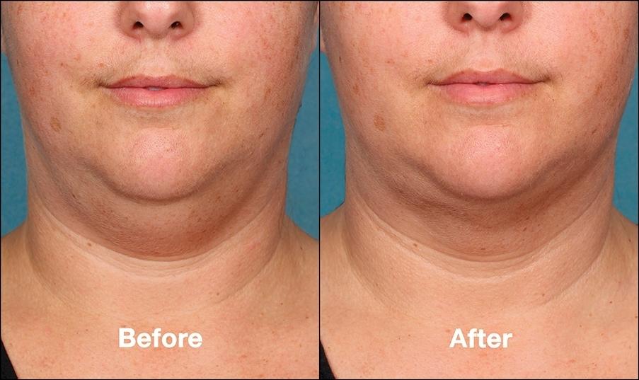 Double Chin, Kybella: Patient 1 - Before and After  